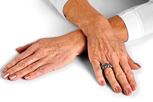 Hand skin with age -related changes that require the use of rejuvenation techniques