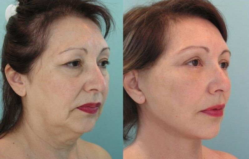 The result of rejuvenating the facial skin tightens with threads