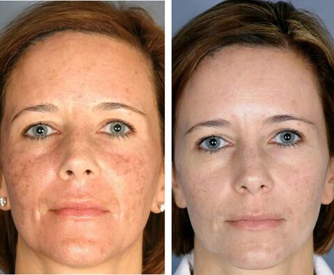 Before and after fractional face thermolysis