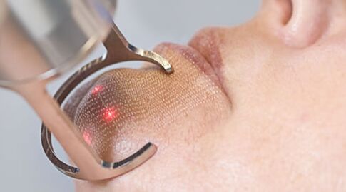 Course of procedures for facial skin rejuvenation of fractional laser