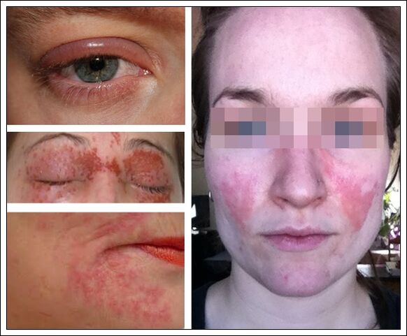 allergies to anti-aging masks