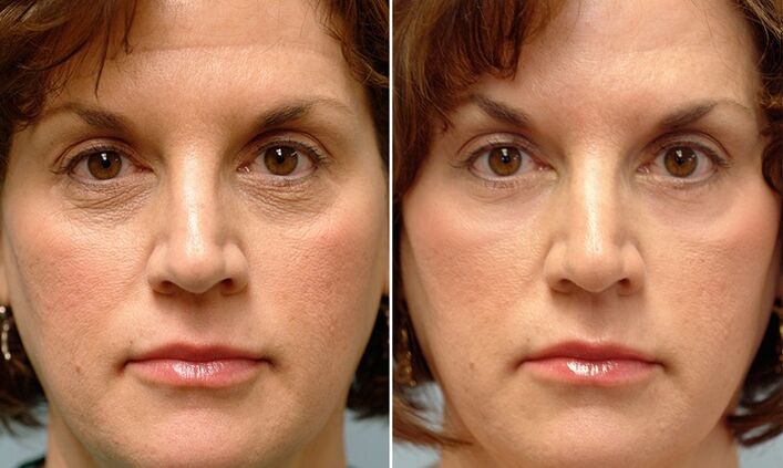 face before and after laser re -fracture