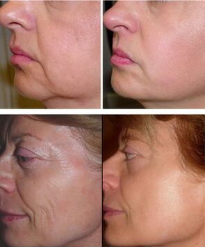 photos before and after laser fractional rejuvenation